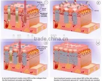 portable Fractional Co2 Laser Surgical Products
