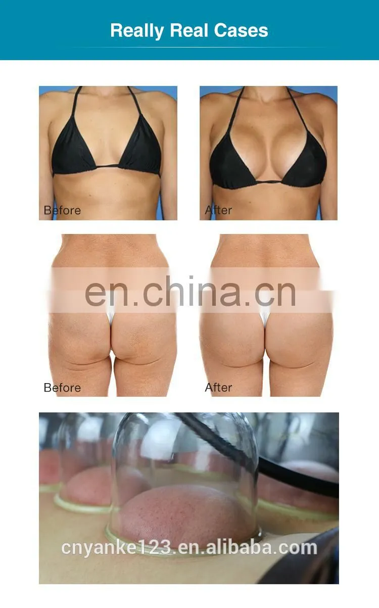 Hotsale buttock enlargement machine/buttock lifting machine/buttock enhancement vacuum butt lifting machine