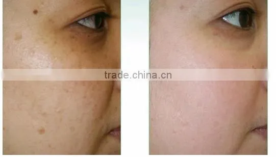most effective!!! 2014 skin rejuvenation oxygen jet peel for sale