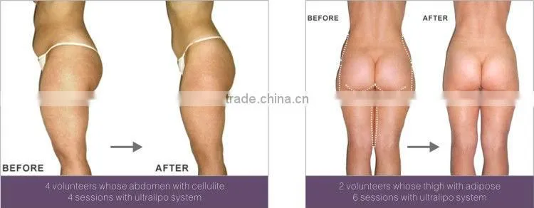 Hot!! Portable fat cavitation slimming machine S50(CE&ISO)cavitation rf tripolar slimming machine
