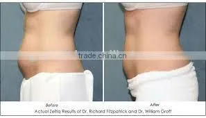 new design fat reduction cryo weight loss machine for double chin
