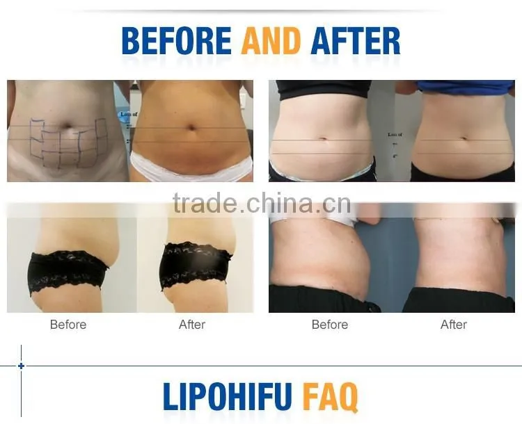 2015 Usa Popular Fat Killer liposonic / Lipo Hifu / liposonix machine