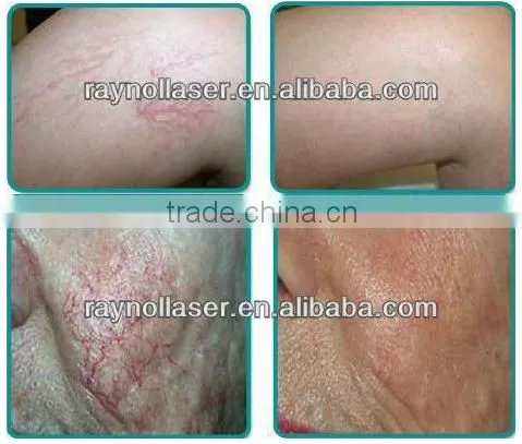 Raynol Beauty Salon Equipment Spider Vein Removal For Facial Redness Vascular Removal Device