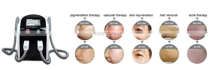 professional SHR machine/OPT/ipl beauty equipment for hair removal