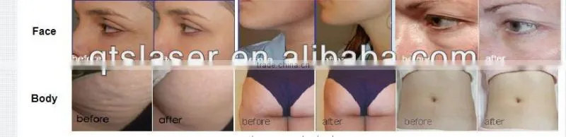 cavitation and vacuum slimming machine /cryo + rf