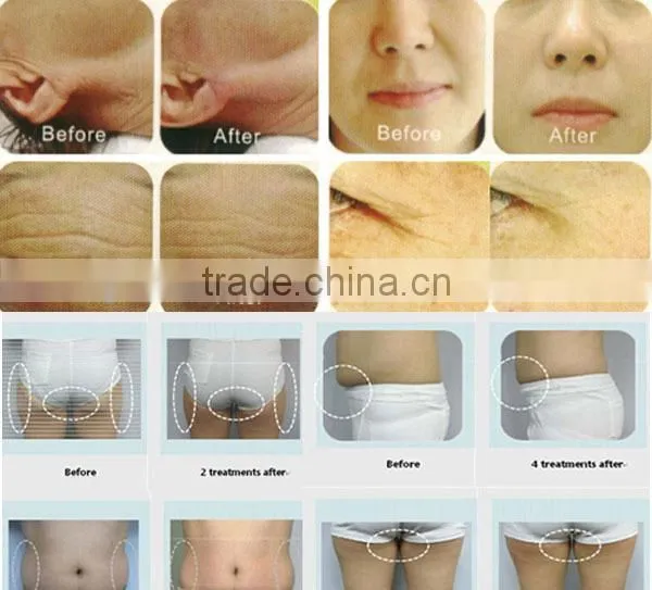 Multifunction vacuum rf laser system/best ultrasound cavitation weight loss machine