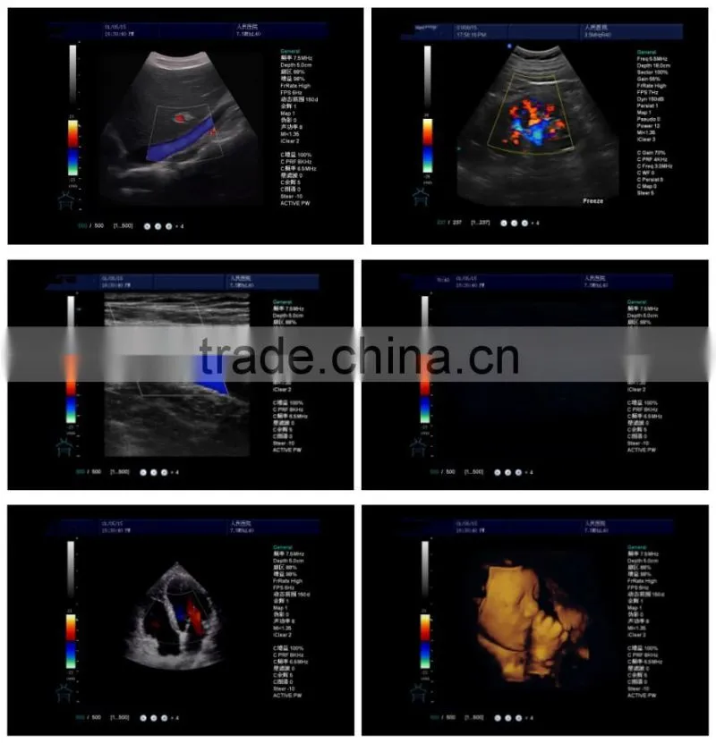 Color Doppler Ultrasound