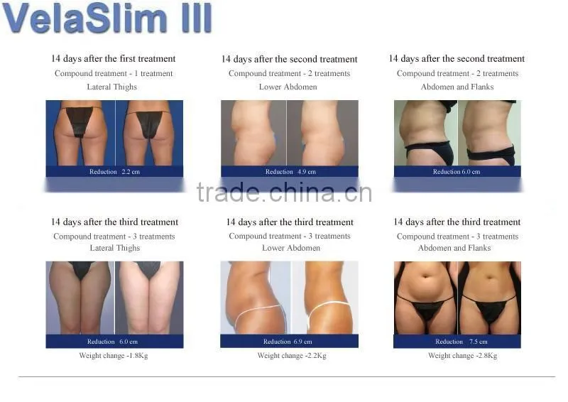 Velaslim body shaping laser fat burning machine
