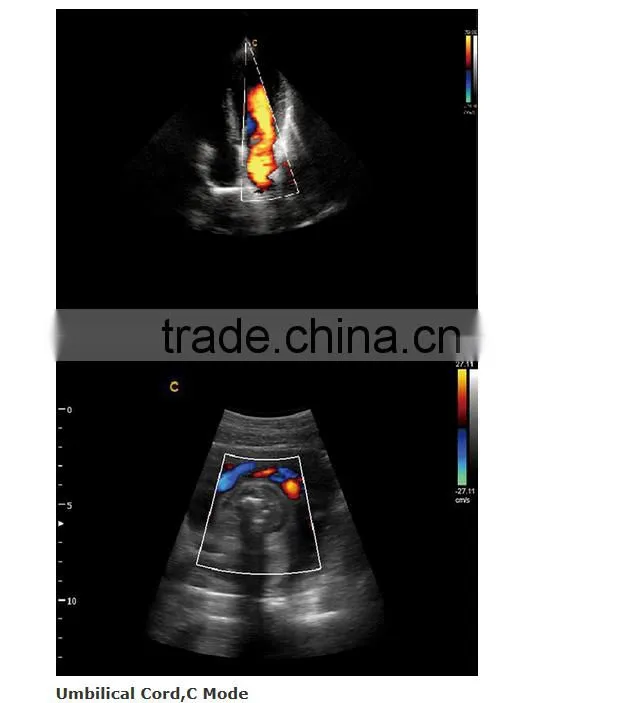 2016 new Portable Color Doppler(Optional 4D) for cardiac use