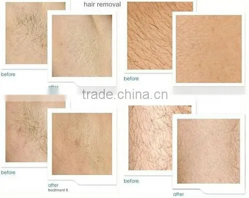 Multi-functional diode laser beauty machine for hair removal/skin whitening and lift/acne treatment