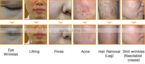 Portable e-light(ipl rf) beauty equipment ipl photo facial machine