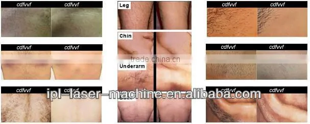 Permanent hair removal painless protable ipl skin treatment system