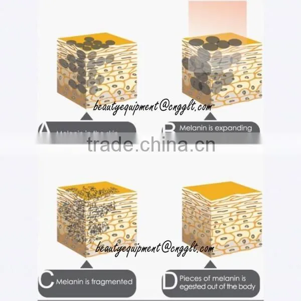 Factory price tattoo removal costs for black , red, brown,colorful tattoo