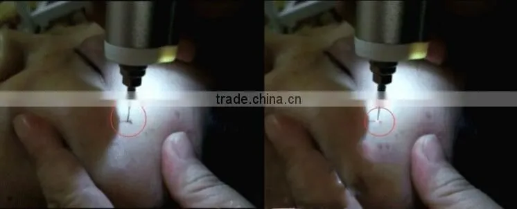 Portable rechargeable Plasma Pen Skin Treatment Soft Surgery Device