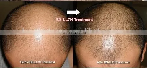 2015 hot sale! PDT laser led hair regrowth machine (CE approval) BS-LL7H