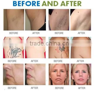 NEW technology High power hair removal e-light ipl rf nd yag laser multifunction machine