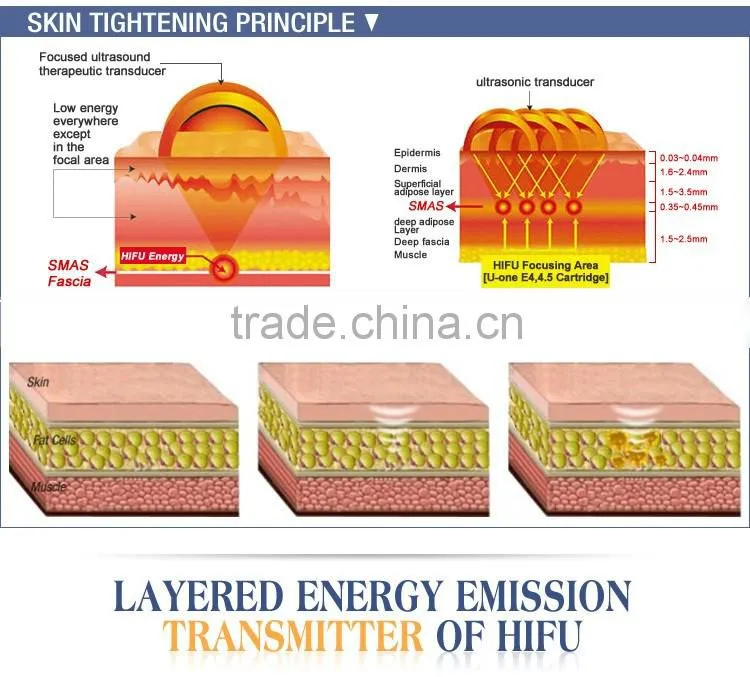 High Intensity Focused Ultrasound Hifu/ Hifu Anti-wrinkle With Amazing Effect