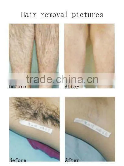 808nm Diode Laser Encounter Smooth Skin 2012