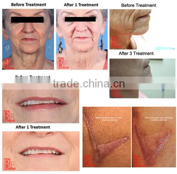 2015 hottest korea auto micro derma pen needles