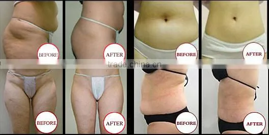 Hot sale weight loss cryotherapy body slimming machine