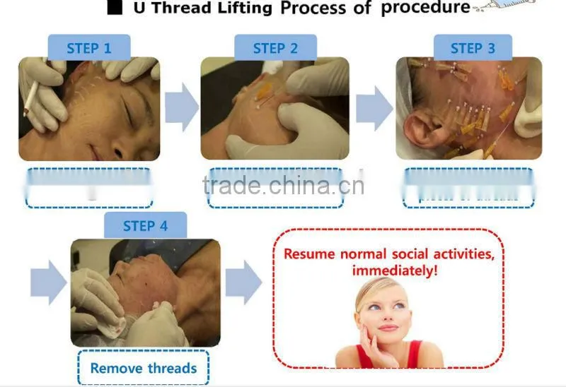 Dynamics of Thread Lifting ,Contour Thread Lift