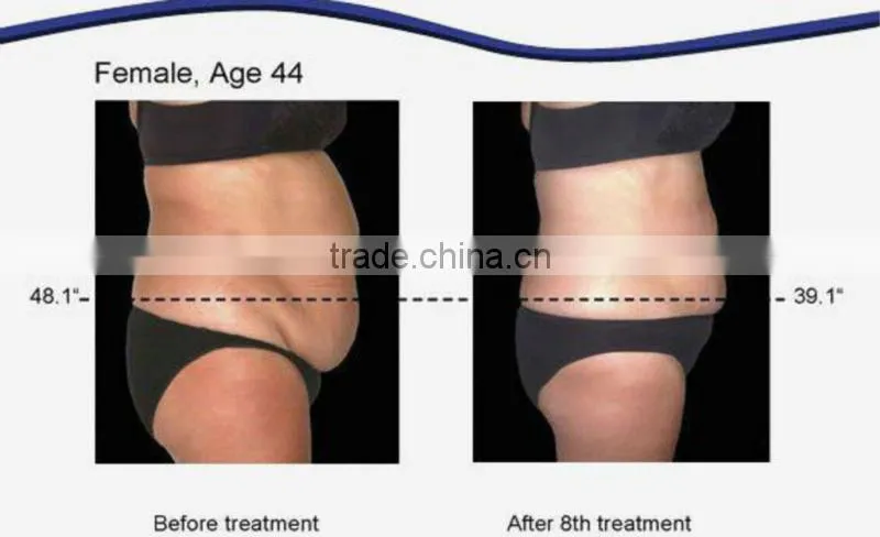 guangzhou supplier lipo laser slimming machine for reduce fat