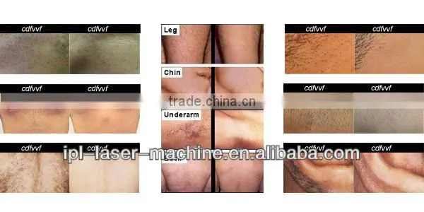 Quickest distributor lowest price with 3 treatment heads professional best result rio ipl hair removal