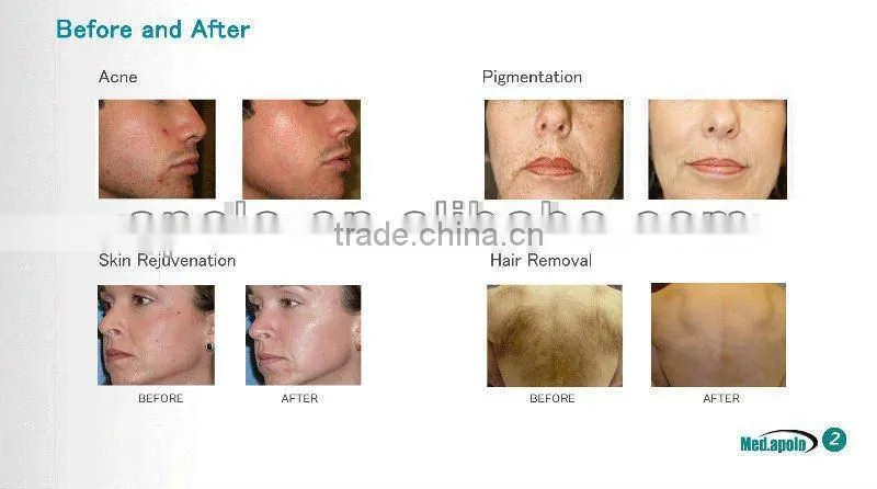 Vertical non-invasive Elight ipl foto depilacion maquina