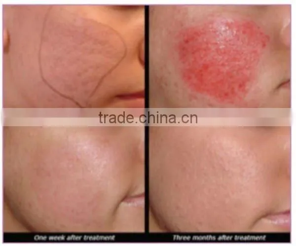 540 needles microneedle derma roller therapy ZGTS beauty roller
