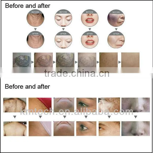 Big promotion!! hot e-light threading hair removal