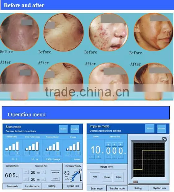 fractional co2 laser scar and pigment removal device/co2 laser for skin rejuvenation