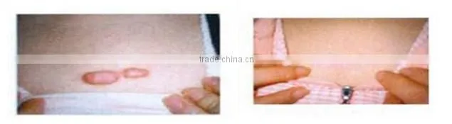 effective co2 fractional laser skin rejuvenation, co2 laser tube with CE approval