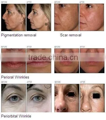 2016 Medical co2 skin therapy equipment fractional co2 laser/vaginal rejuvenator laser