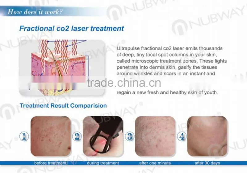 2015 Newest Co2 Fractional Laser Equipment Dermatology CO2 Fractional Laser With Gynecology Heads