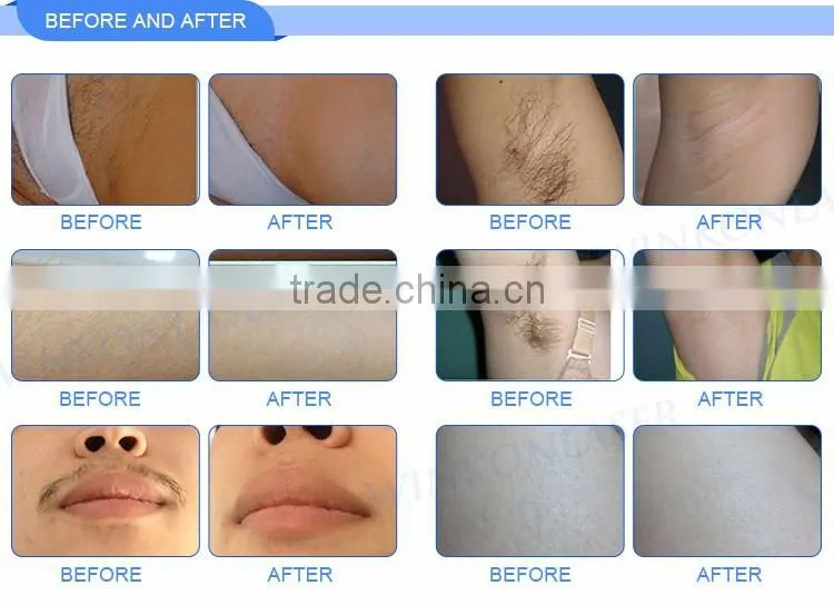 2500w 10mm*16mm (6 bar) infrared permanent diode laser 808nm hair removal machine