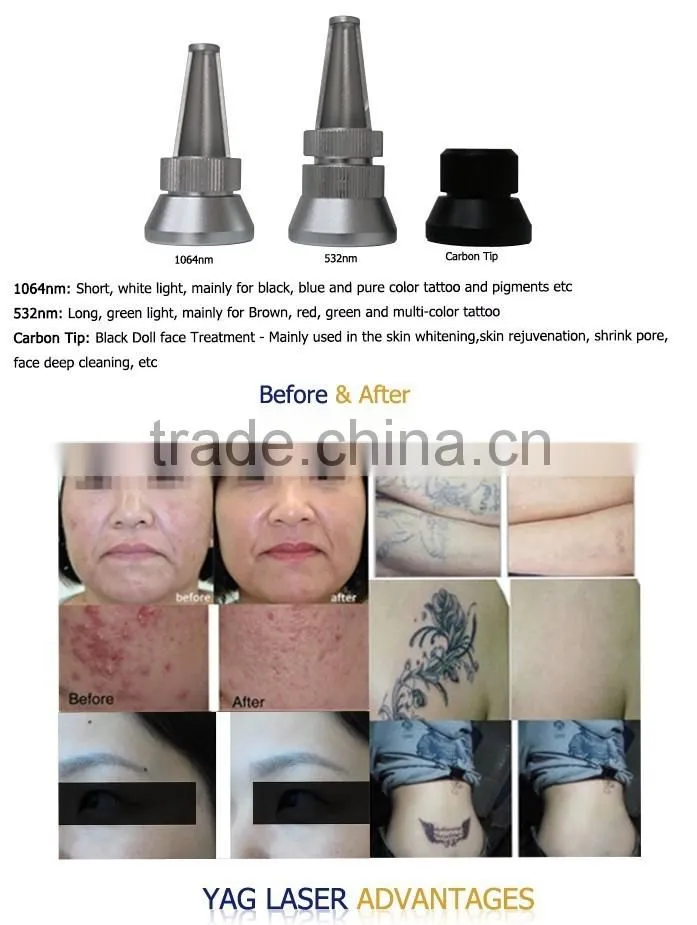 electric tattoo remover 532nm 1064nm active q switch nd yag laser pigment removal