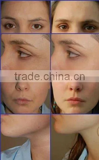 beauty facial pdt skin whitening rf galvanic facial salon machine