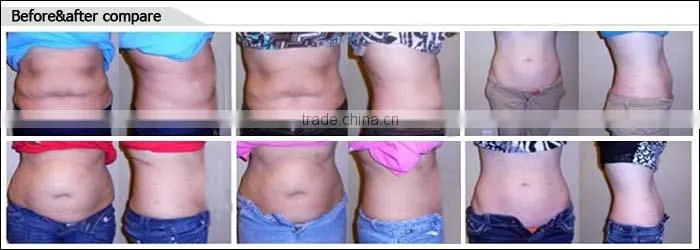 2014 Hottest best portable laser weight loss machine for home