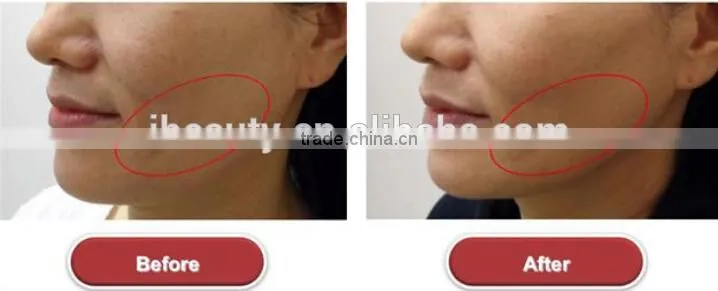 2015 professional portable HIFU High Intensity Focused Ultrasound HIFU with 3 tips for wrinkle removal
