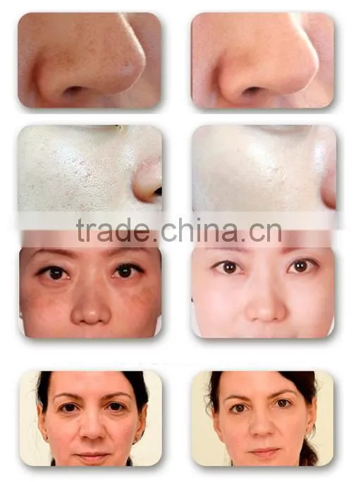 EYCO RF skin renewal device CE&Rhos 2016 new product skin radio frequency radio frequency facial skin tightening skin tighteni