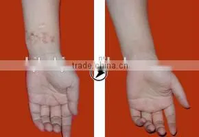 RF co2 franctional laser with auto intelligent controller for acne Scar remover
