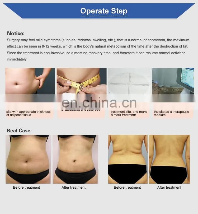 airsculpt reduct fat hifu fat removal liposonic machine