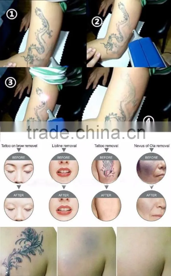 portable q switch nd yag laser tattoo removal,black doll skin rejuvenation TM-J116