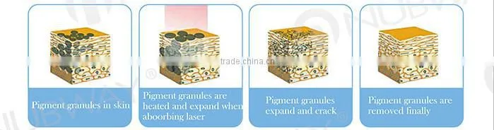 Medical laser tattoo removal equipment/nd yag laser tattoo removal equipment/tattoo removal equipment supplier