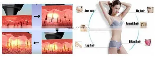 promotion shr hair removal hair removal ipl machine