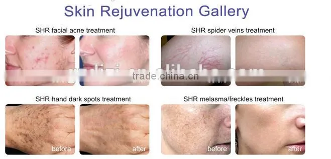 IPL/permanent hair removal,laser hair removal machine