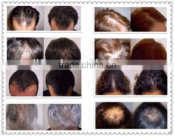 Hair growth electric scalp stimulator device