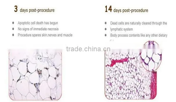 New design in 2016 fast slimming equipment cryolipolysis machine lose weight from china