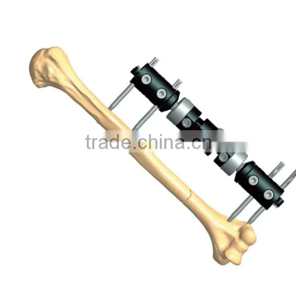 Bone Lengthening Fragment External Fixator