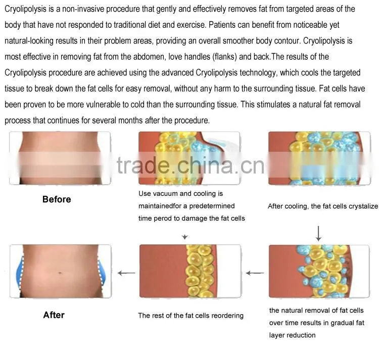Cryo Handles Faeeze Cavitation Slimming Machine Cool Tech Shape Fat Freezing Lipo Machine